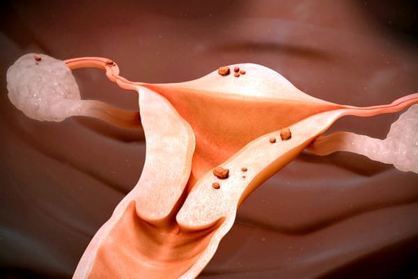 Endometrioza a In Vitro i szanse na ciążę