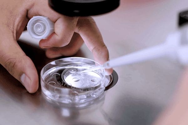Stymulacja jajników i punkcja przy endometriozie
